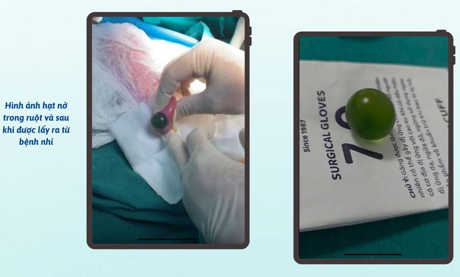 Cấp cứu tắc ruột ở trẻ 13 tháng tuổi do nuốt hạt nở